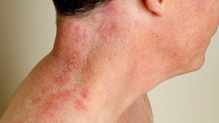 What is the Severity of Shingles?